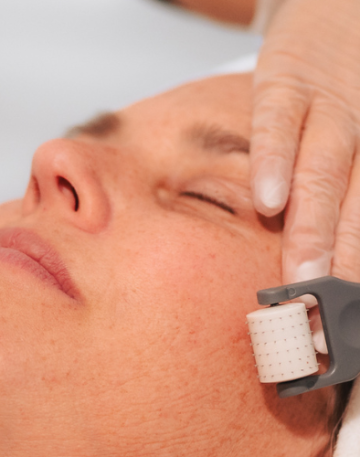 best skin needling in bondi beach sydeny